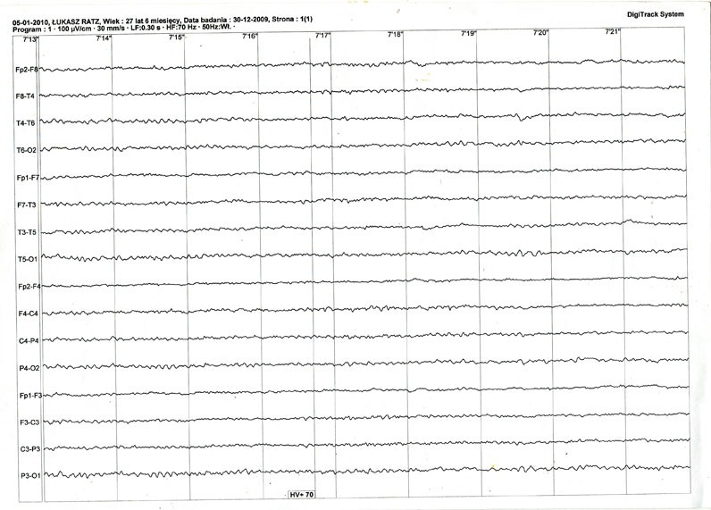 EEG 1