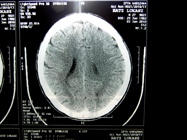 MRI 5