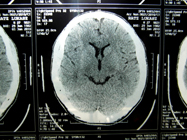 MRI 11