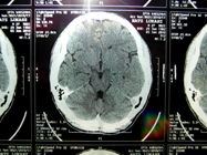 MRI 14