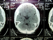 MRI 15