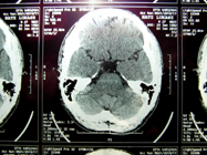 MRI 18
