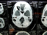 MRI 23
